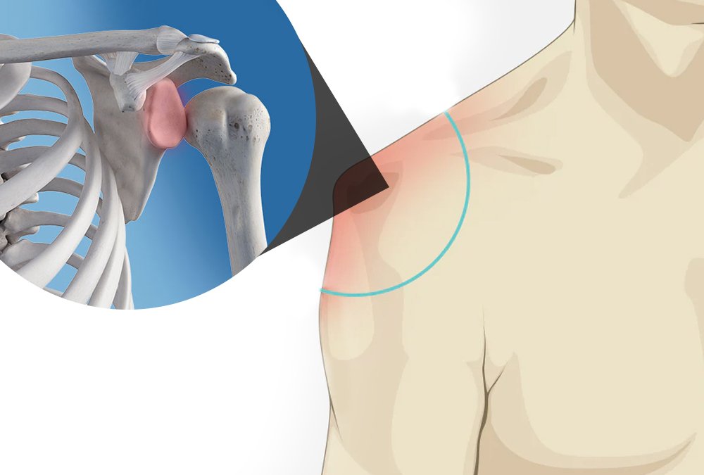 Luxação do ombro, esclareça todas as suas dúvidas